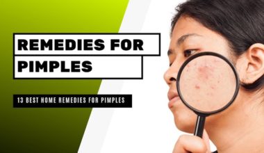 Best Home Remedies for Pimples