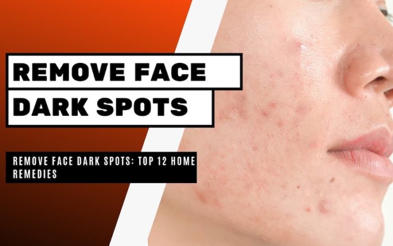 Home Remedies to Remove Dark Spots on Face