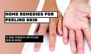 12 Home Remedies for Peeling Skin on Hands