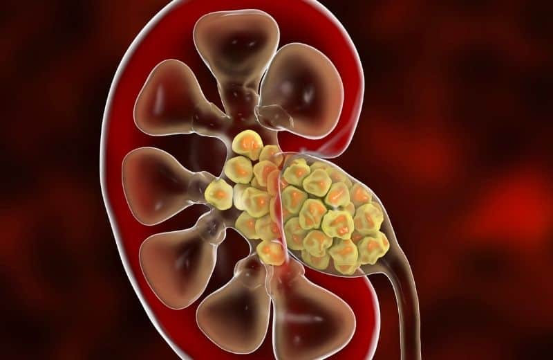 Causes of Kidney Stones